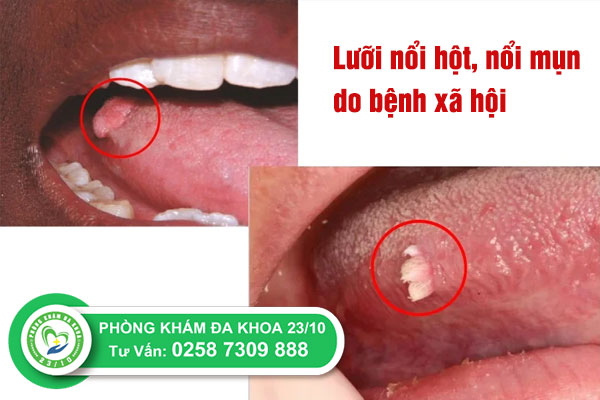 luoi noi hot la dau hieu cua benh gi