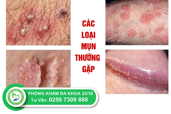 Các triệu chứng đáng lưu ý khi mắc phải mụn sinh dục
