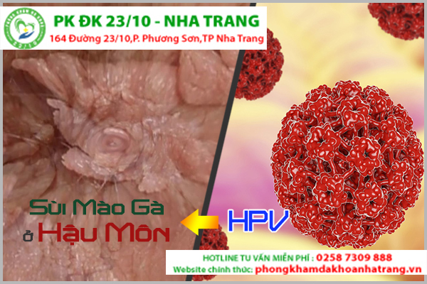 Sùi mào gà ở mông