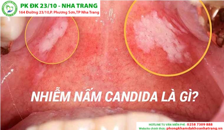 NHIỄM NẤM CANDIDA VÀ CÁCH ĐIỀU TRỊ HIỆU QUẢ