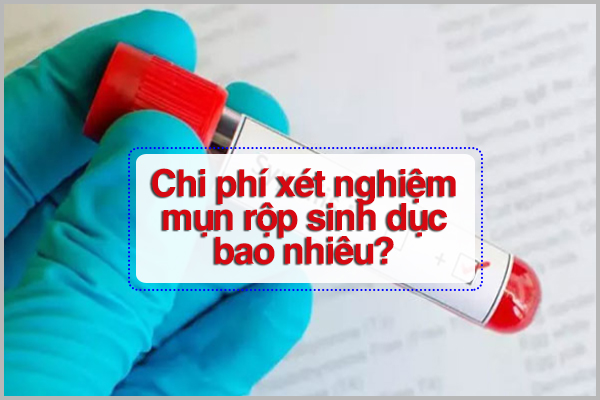 CHI PHÍ XÉT NGHIỆM MỤN RỘP SINH DỤC LÀ BAO NHIÊU TIỀN?