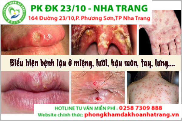 Những hình ảnh của bệnh lậu ở những vị trí khác trên cơ thể