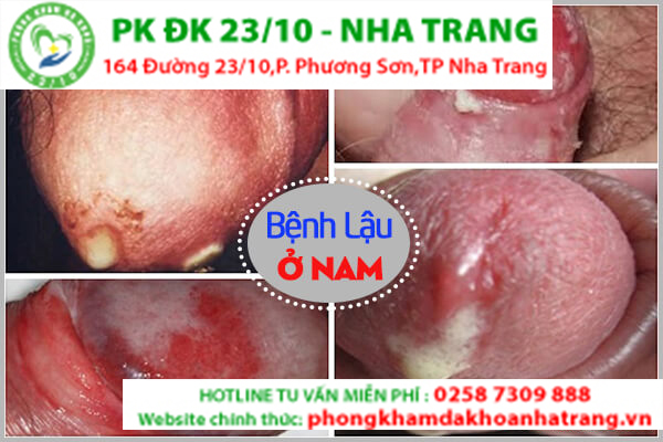 Những hình ảnh của bệnh lậu ở nam giới