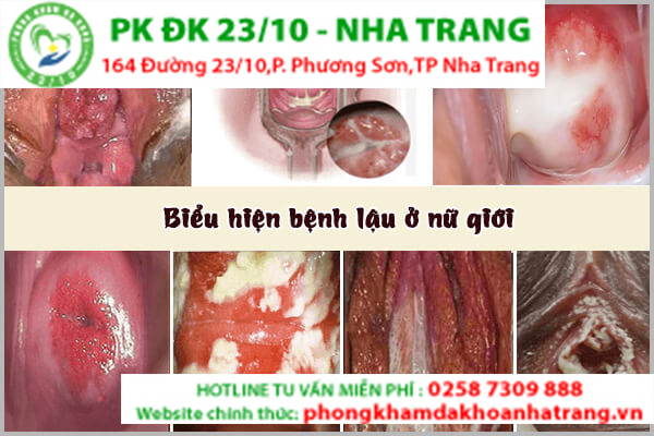 Những hình ảnh của bệnh lậu ở nữ giới